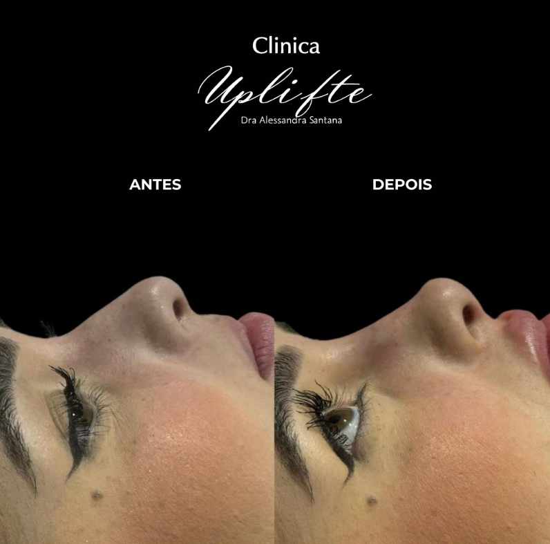 Resultado Antes e Depois 1