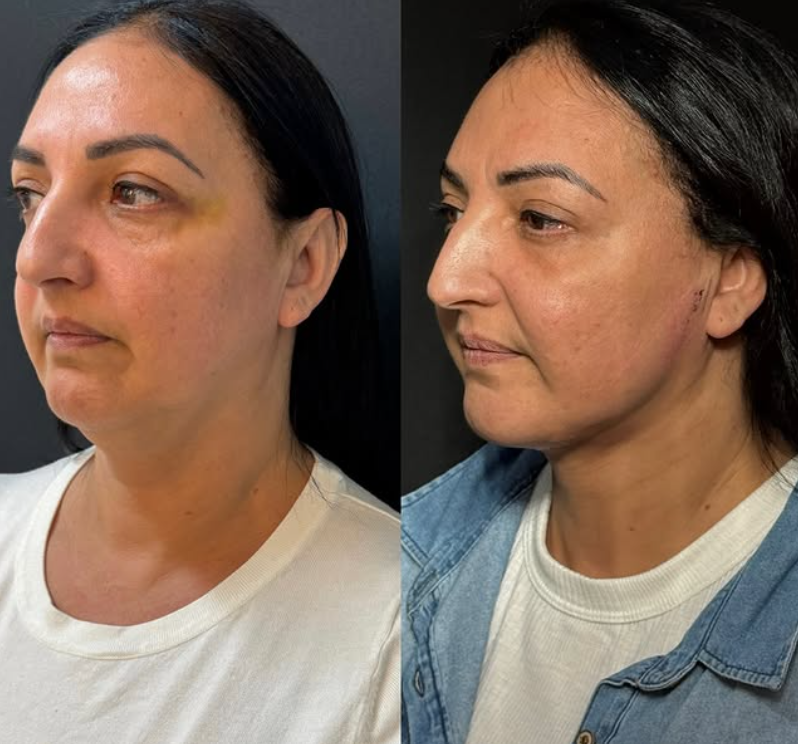 Resultado Antes e Depois 2