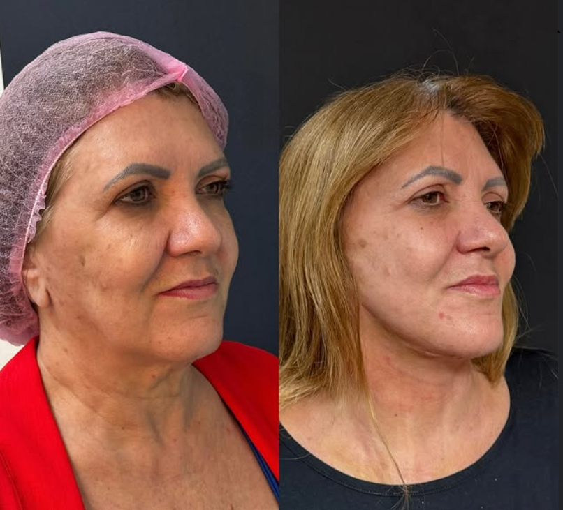Resultado Antes e Depois 3